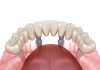 All on Four Dental Implants All on 4 Implants in Istanbul