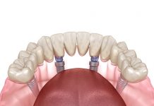 All on Four Dental Implants All on 4 Implants in Istanbul