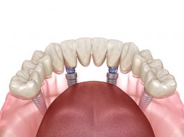 All on Four Dental Implants All on 4 Implants in Istanbul