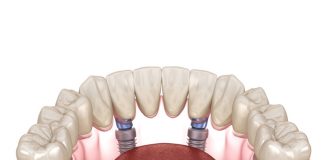 All on Four Dental Implants All on 4 Implants in Istanbul
