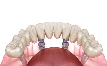 All on Four Dental Implants All on 4 Implants in Istanbul