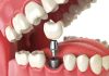 Dental Implantation Dental Implantation in Istanbul