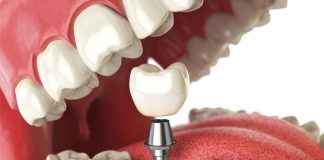 Dental Implantation Dental Implantation in Istanbul