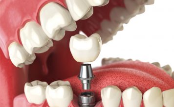 Dental Implantation Dental Implantation in Istanbul