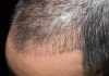 FUT Hair Transplant FUT Hair Transplant in Istanbul
