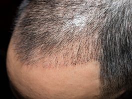 FUT Hair Transplant FUT Hair Transplant in Istanbul