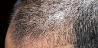 FUT Hair Transplant FUT Hair Transplant in Istanbul