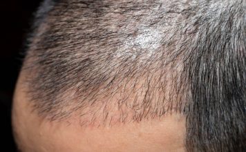 FUT Hair Transplant FUT Hair Transplant in Istanbul