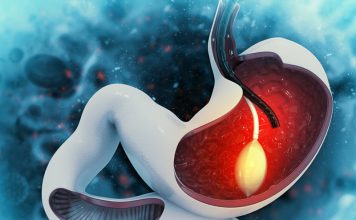 Gastric Balloon Gastric Balloon in Istanbul