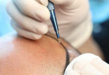 Sapphire FUE Hair Transplant Sapphire FUE Hair Transplant in Istanbul