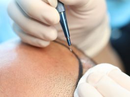 Sapphire FUE Hair Transplant Sapphire FUE Hair Transplant in Istanbul