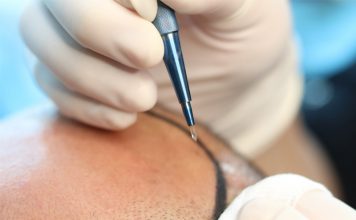 Sapphire FUE Hair Transplant Sapphire FUE Hair Transplant in Istanbul