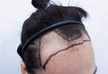 Unshaven Hair Transplant Unshaven Hair Transplant in Istanbul