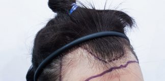 Unshaven Hair Transplant Unshaven Hair Transplant in Istanbul