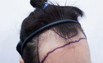 Unshaven Hair Transplant Unshaven Hair Transplant in Istanbul