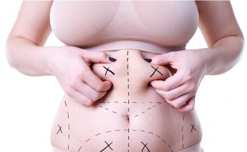 Vaser Liposuction Vaser Liposuction in Istanbul
